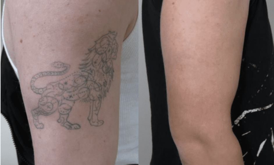 Före och efter tatueringsborttagning, lejontatuering på överarm