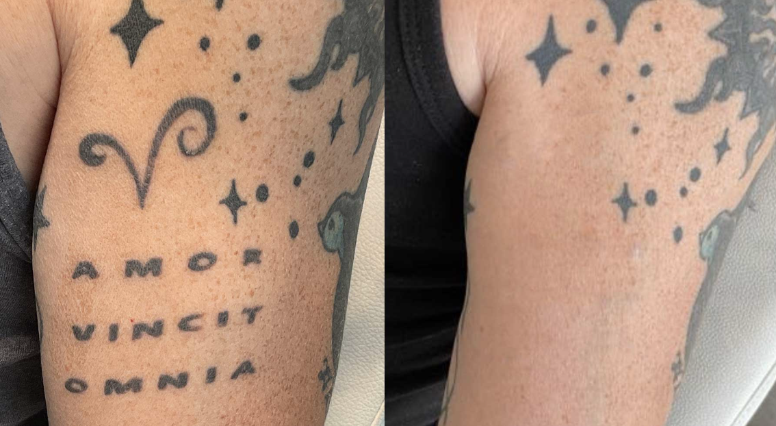 Före och efter tatueringsborttagning, text på underarm