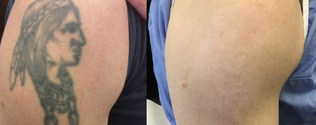 Före och efter tatueringsborttagning, porträtttatuering